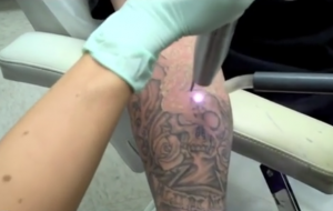 how_a_tattoo_is_removed_with_laser